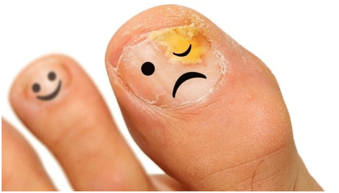 9 maneiras caseira e eficazes para se livrar do fungo das unhas unhas dos pés com fungos